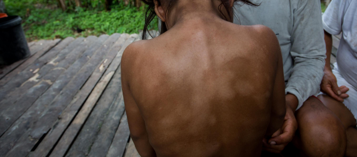 a woman with skin problems on her back